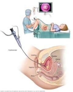 diagnostic cystoscopy for women