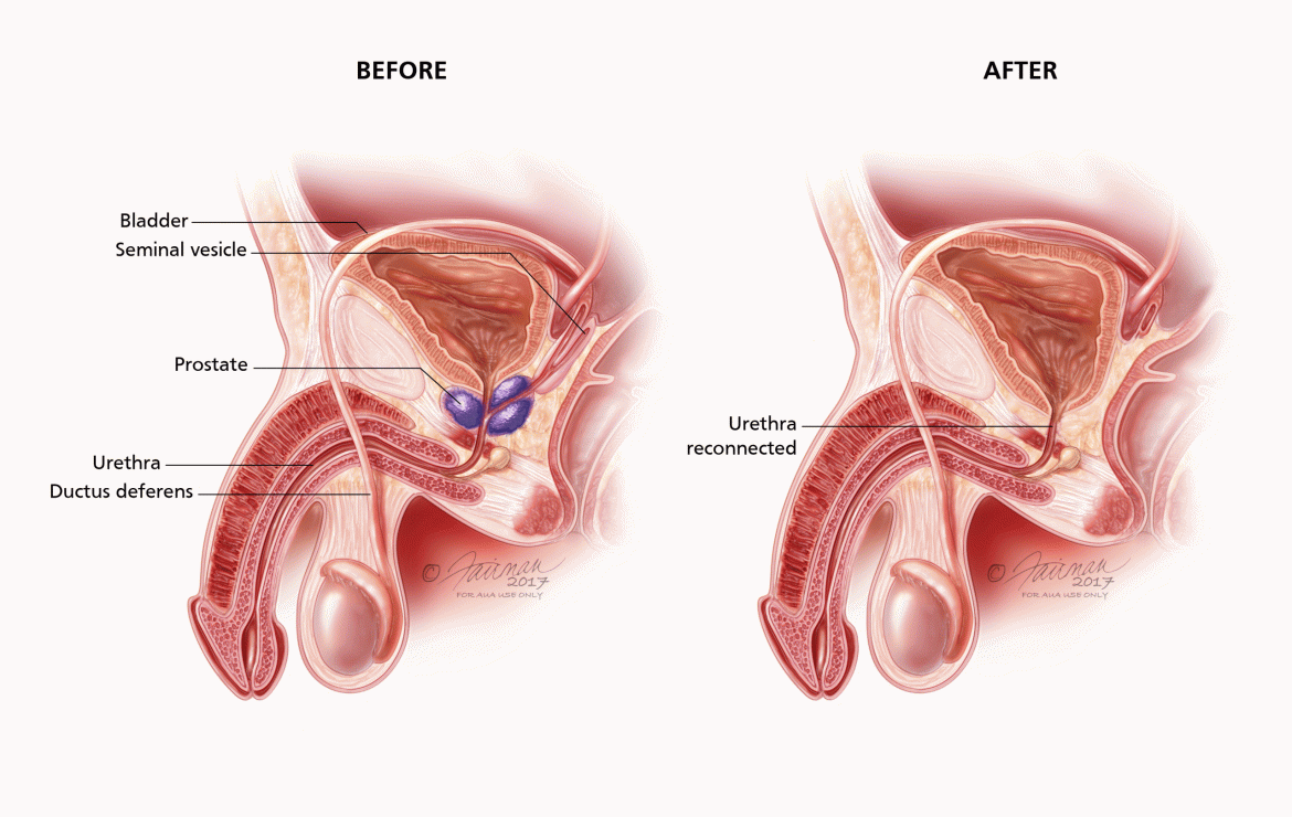 Enlarged Prostate or Prostate Cancer? Advances in Screening, Treatment and Preserving Quality of Life