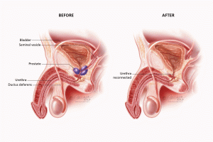 Enlarged Prostate or Prostate Cancer? Advances in Screening, Treatment and Preserving Quality of Life