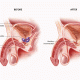 Enlarged Prostate or Prostate Cancer? Advances in Screening, Treatment and Preserving Quality of Life