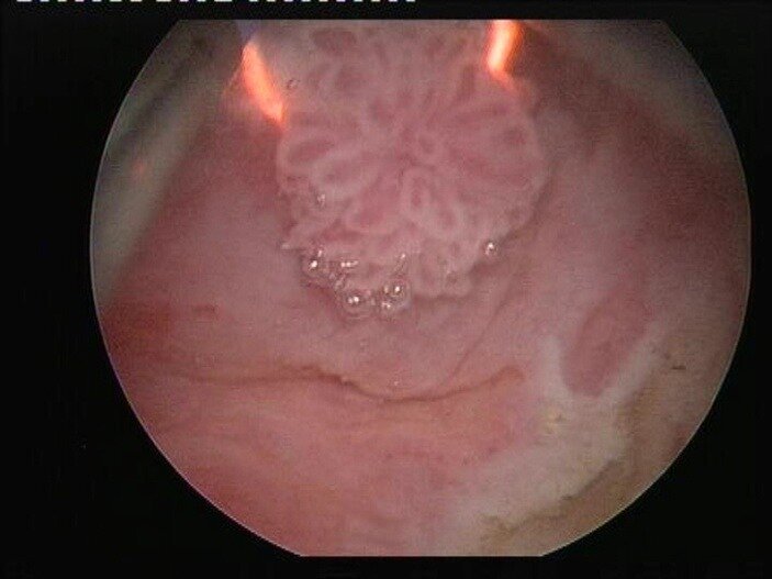 transurethral resection of bladder tumours