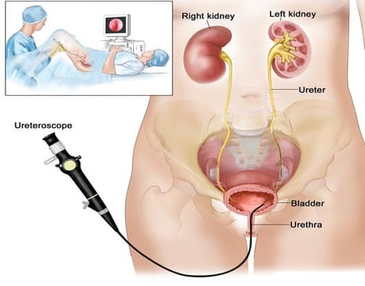 Ureteroscope