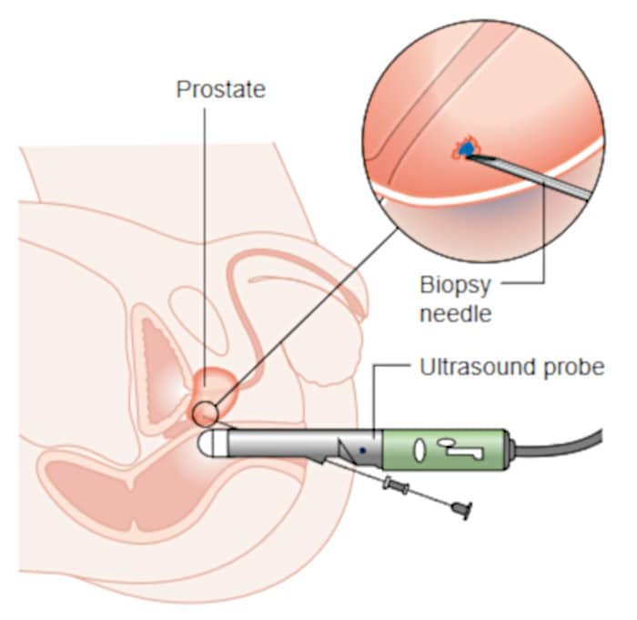 transrectal biopsy