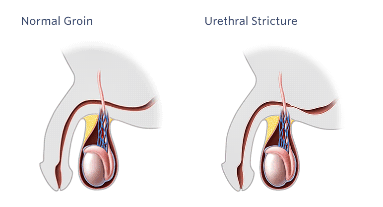 Urethral Stricture